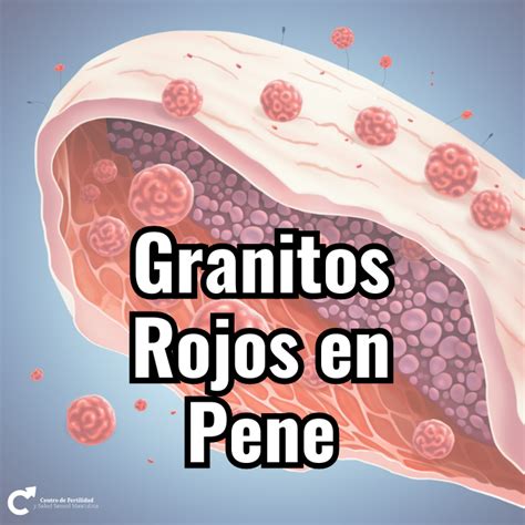 granitos en el oene|Por qué salen granitos en el pene